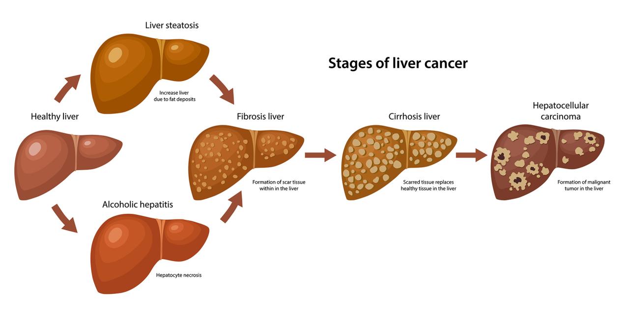 Stages Of Liver Cancer | Cyberknife Treatment Center Miami