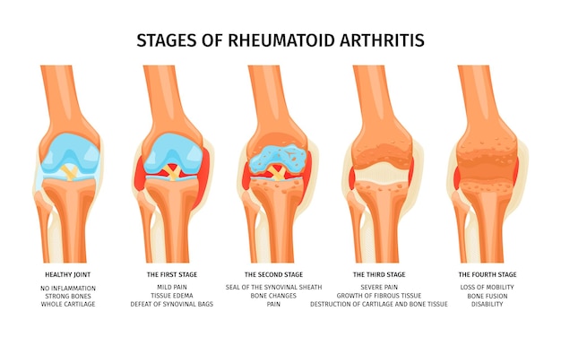 Free Vector | Realistic Infographics Showing Four Stages Of Rheumatoid  Arthritis Of Knee Joint Vector Illustration
